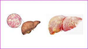 5 reason for liver diseases