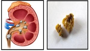 WHY KIDNEY STONES REOCCUR REPETEDLY IN ONE MAN