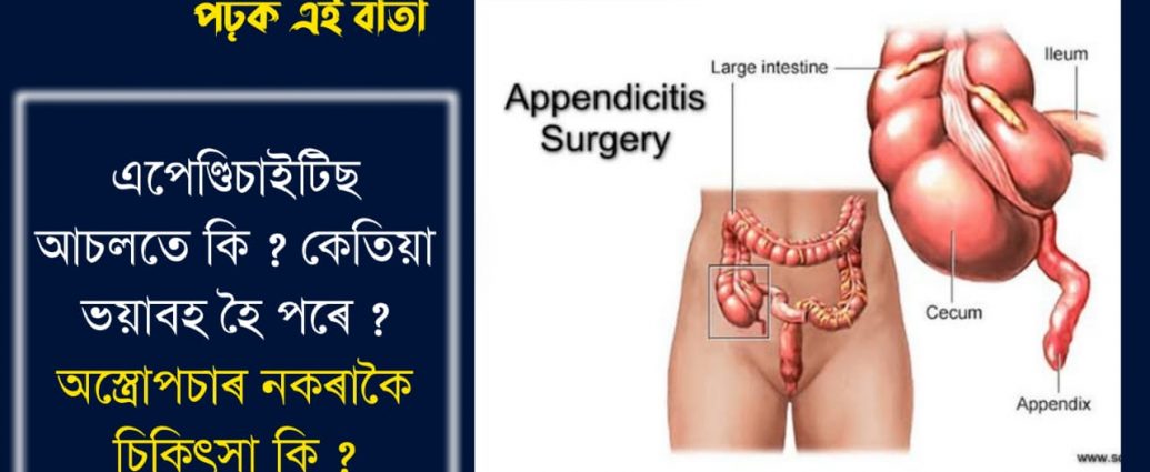 SIGNS SYMPTOMS AND TREATMENT OF APPENDICITIS