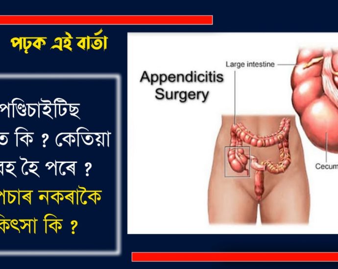 SIGNS SYMPTOMS AND TREATMENT OF APPENDICITIS
