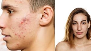 Remedies for acne and pimples